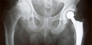 best hip replacement hospital