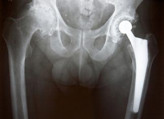 best hip replacement hospital