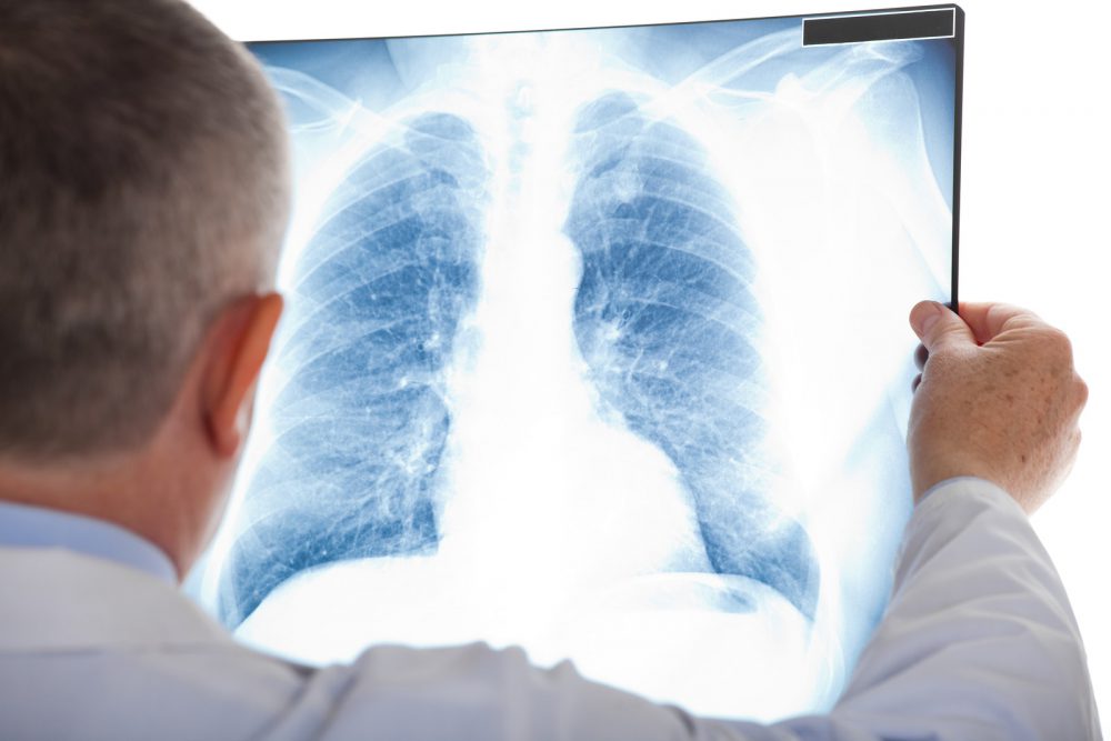 Lung Cancer Screenings 