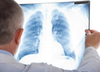 Lung Cancer Screenings